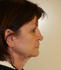 Facelift Case 3 - before - side