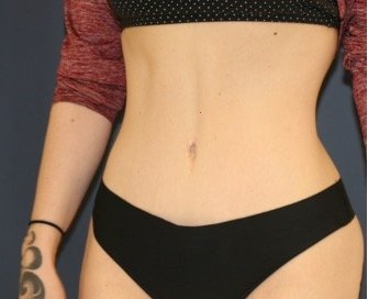 Tummy Tuck 240 - after - oblique