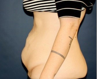 Tummy Tuck 240 - before - side