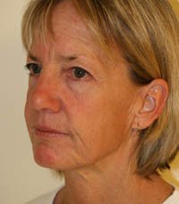Facelift Case 8 - before - oblique
