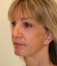 Facelift Case 8 - after - oblique