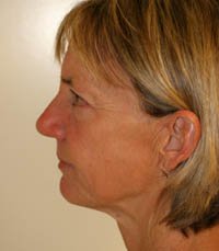 Facelift Case 8 - before - side