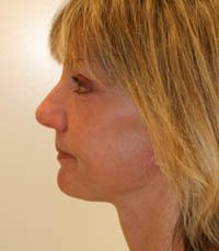 Facelift Case 8 - after - side