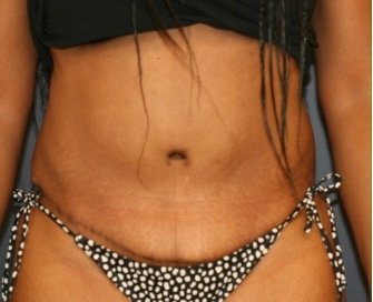 Tummy Tuck 241 - after - front