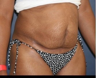 Tummy Tuck 241 - before - oblique