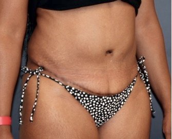 Tummy Tuck 241 - after - oblique