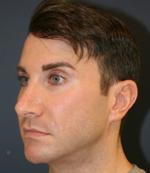 Revision Rhinoplasty 205 - before - front