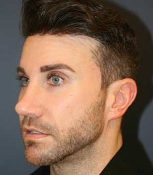 Revision Rhinoplasty 205 - after - front