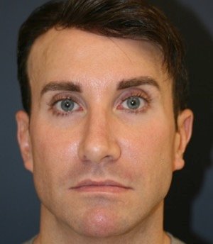 Revision Rhinoplasty 205 - before - oblique