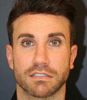 Revision Rhinoplasty 205 - after - oblique