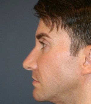 Revision Rhinoplasty 205 - before - side