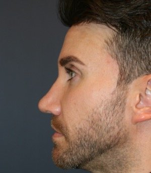 Revision Rhinoplasty 205 - after - side