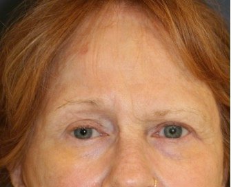 Browlift Case 105 - before - front