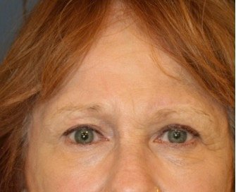 Blepharoplasty 109 - after - front