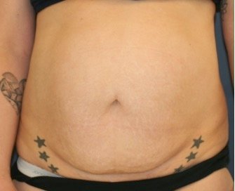 Tummy Tuck 242 - before - front