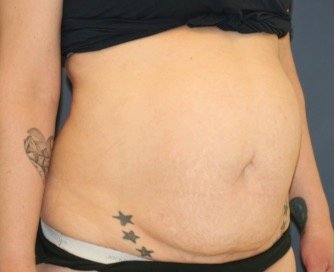 Tummy Tuck 242 - before - oblique
