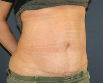 Tummy Tuck 242 - after - oblique