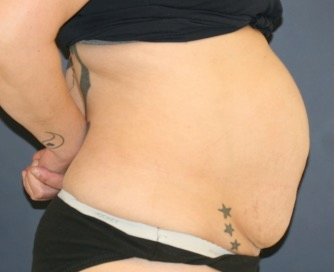 Tummy Tuck 242 - before - side