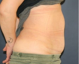 Tummy Tuck 242 - after - side