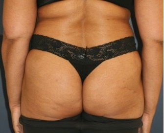 BBL Fat Transfer 18 - before - front