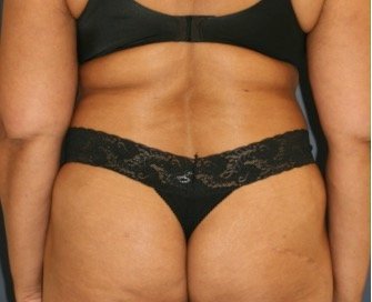 Liposuction Back-Flanks 212 - before - front