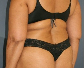 Liposuction Back-Flanks 212 - before - oblique