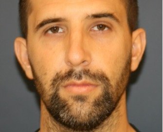 Rhinoplasty 213 - before - side