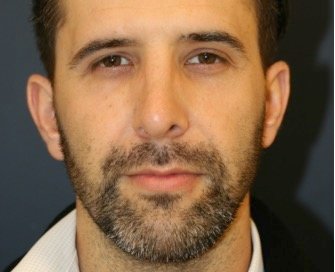 Rhinoplasty 213 - after - side