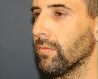 Rhinoplasty 213 - before - oblique