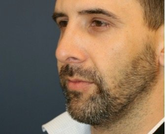 Rhinoplasty 213 - after - oblique