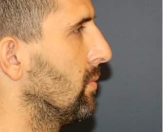Rhinoplasty 213 - before - front