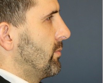 Rhinoplasty 213 - after - front