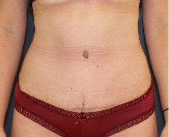 Tummy Tuck 243 - after - front