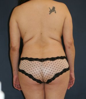 Lipo waist flanks thighs - before - front