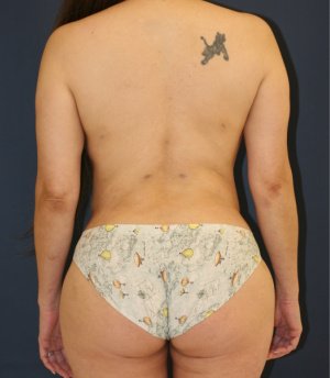 Lipo waist flanks thighs - after - front