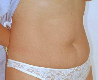 Tummy Tuck Case 2 - before - angle