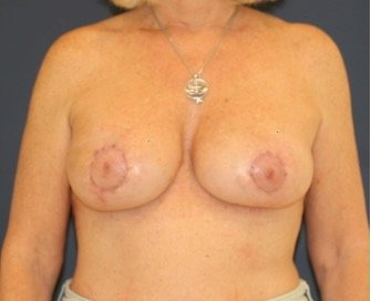 Breast Revision with Augmentation 411 - after - front