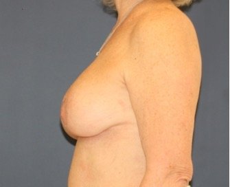 Breast Revision with Augmentation 411 - after - side