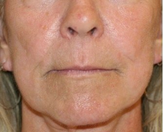 Liplift and Corner Liplift 209 - before - oblique