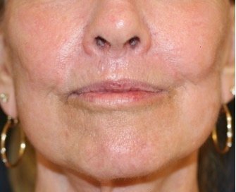 Liplift and Corner Liplift 209 - after - oblique