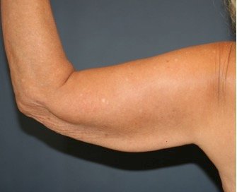 Arm Reduction 214 - before - front