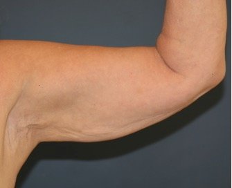 Arm Reduction 214 - before - oblique