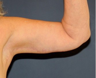 Arm Reduction 214 - after - oblique