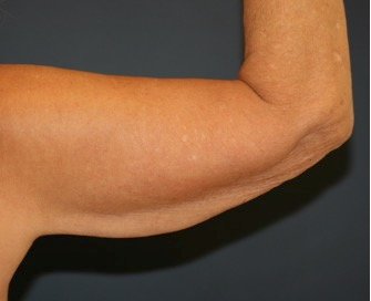 Arm Reduction 215 - before - front