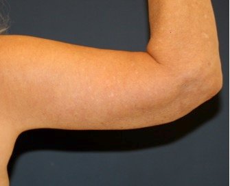 Arm Reduction 215 - after - front