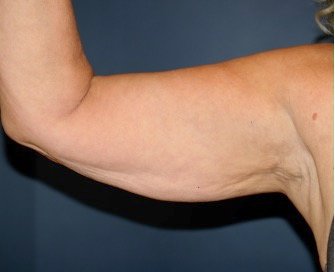 Arm Reduction 215 - before - oblique