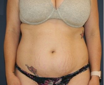 Tummy Tuck 244 - before - front