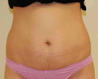 Tummy Tuck Case 9 - before - front