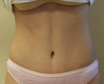Tummy Tuck Case 9 - after - front