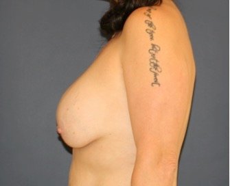 Breast Augmentation Lift 66 - before - side